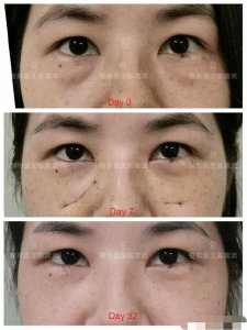 ​去眼袋手术后的真实图（眼袋手术志愿者感慨）