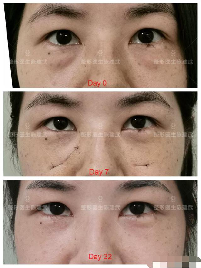 去眼袋手术后的真实图（眼袋手术志愿者感慨）(1)