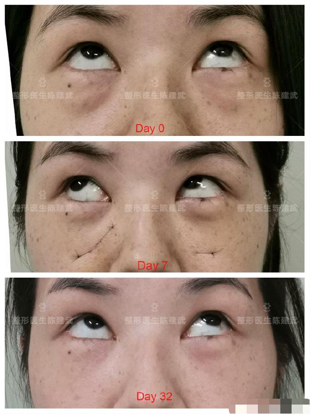 去眼袋手术后的真实图（眼袋手术志愿者感慨）(2)
