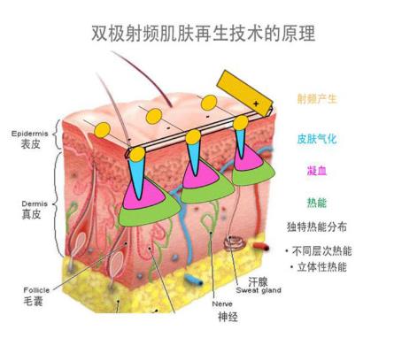 射频美容仪原理是什么 皮薄敏感肌不适合用